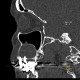 Periapical cyst, radicular cyst: CT - Computed tomography